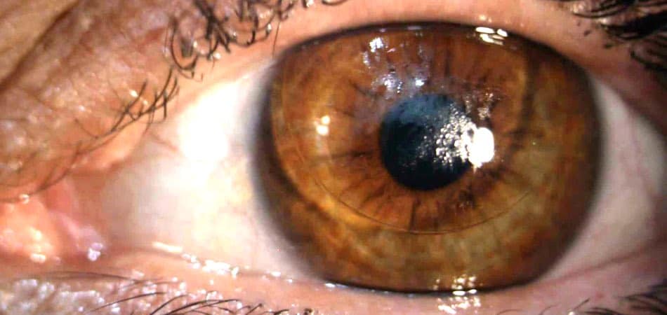 Können sich harte Kontaktlinsen abnutzen? - Die Brillenmacher Wallstadt