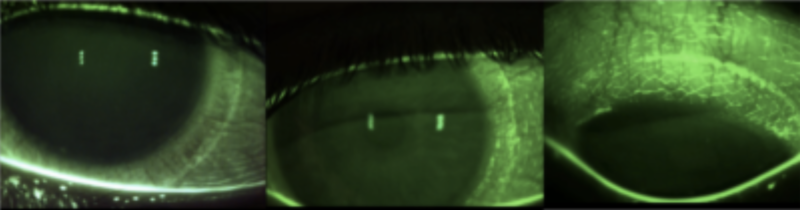 Abdrücke weicher Kontaktlinsen. Sichtbar gemacht mit Fluoreszin