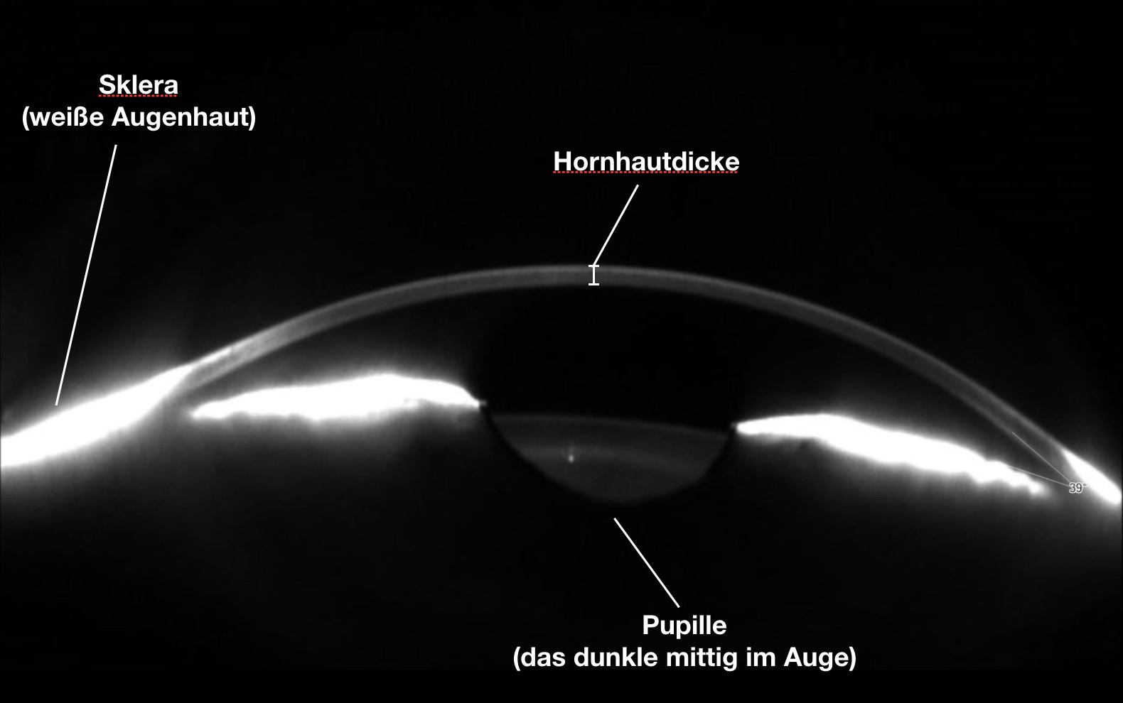 Das Bild zeigt die Hornhautdicke bei einem Auge in der Seitenansicht im Schnitt mit einer Scheimpflugkamera