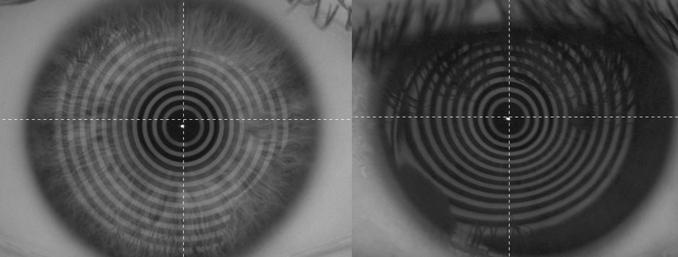 Hier zeigt der Gleitsichtspezialist ein unauffälliges Auge links und rechts eine auffällige Hornhaut, die nicht optimal mit einer Gleitsichtbrille funktionieren wird.