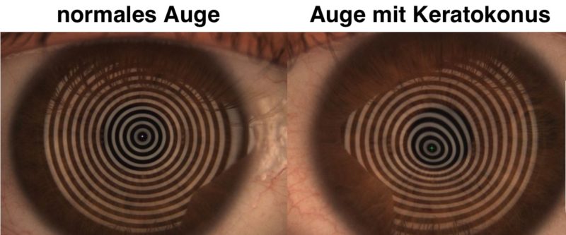 Das Bild zeigt die unterschiedlichen Spiegelungen auf einer Hornhaut mit Keratokonus und einer herkömmlichen Hornhaut