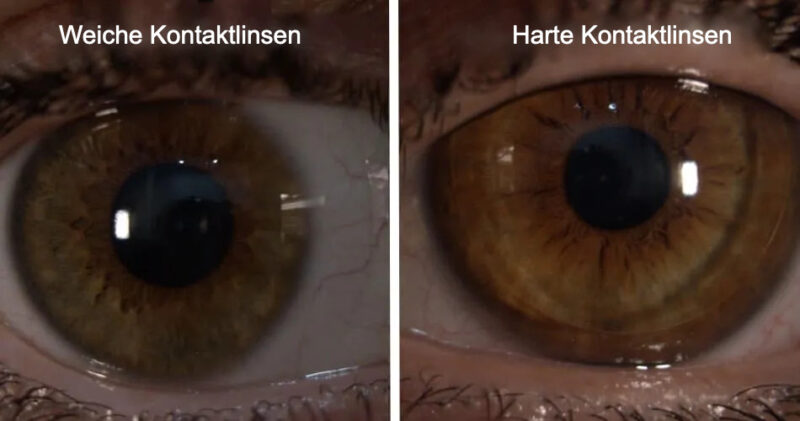 Ich Bekomme Die Kontaktlinsen Nicht Rein Schwierigkeiten beim Herausnehmen von Kontaktlinsen? Einfache Techniken