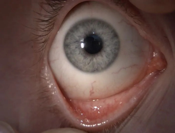 So öffnet man die Augen um die Kontaktlinse einzusetzen